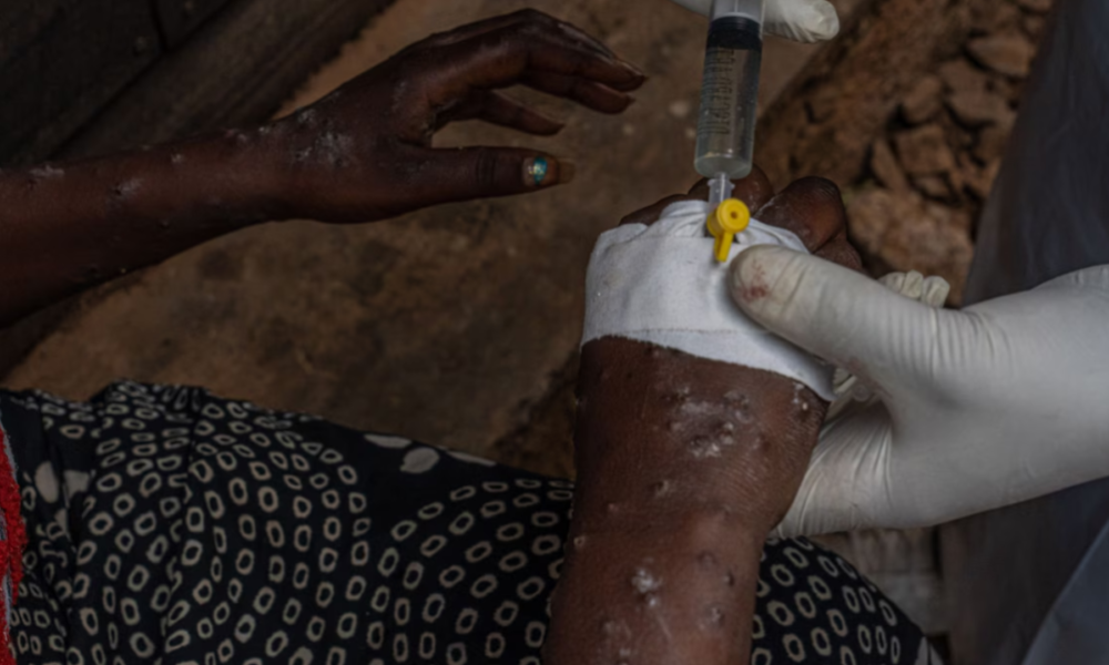 África registra más de 77,000 casos de mpox en 2024