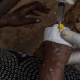 África registra más de 77,000 casos de mpox en 2024