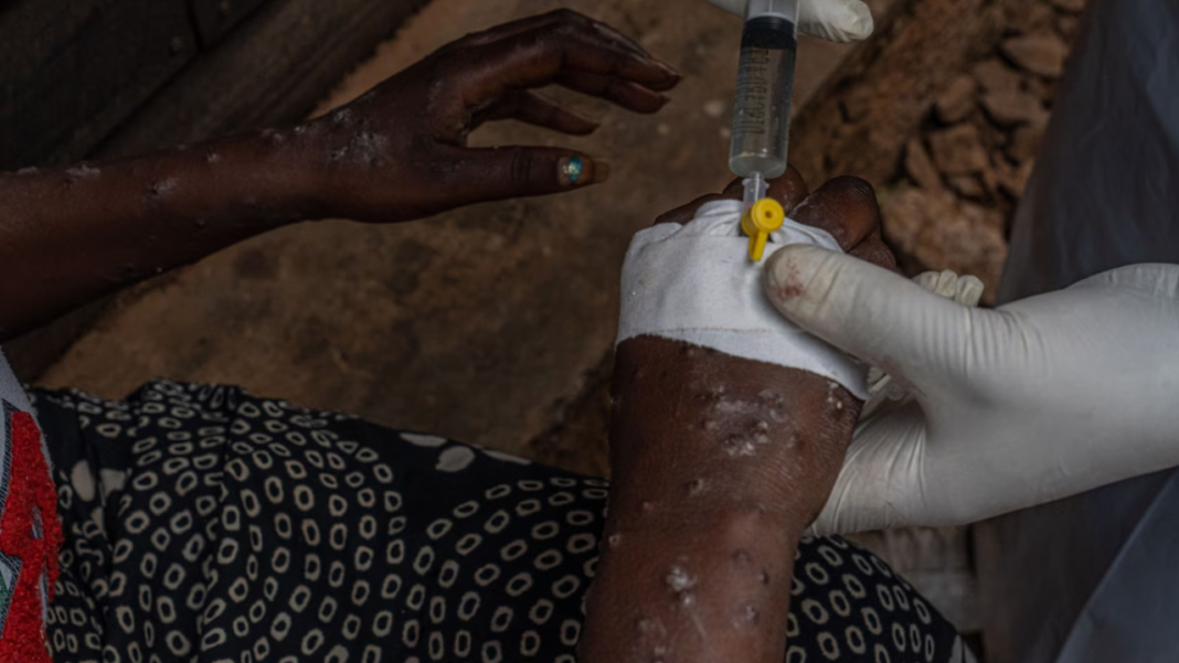 África registra más de 77,000 casos de mpox en 2024